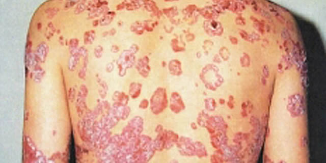 Psoriasis